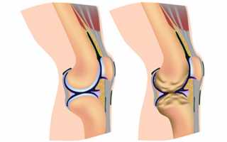 Гонартроз первой степени