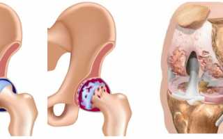 Коксартроз или гонартроз?