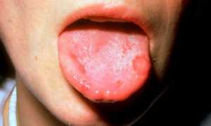 Что делать при ожоге языка: как лечить