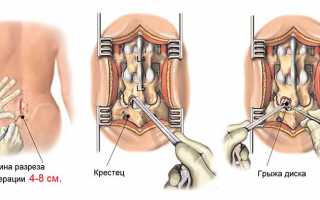 Операция по удалению межпозвоночной грыжи