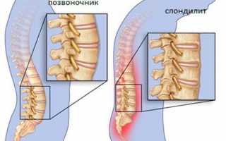 Анкилозный спондилит