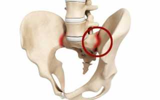 Что такое сакроилеит?