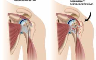 Защемление нерва в плече