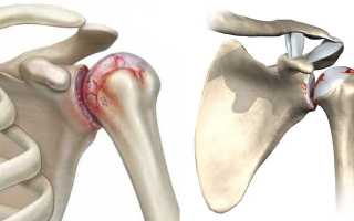 Деформирующий артроз плечевого сочленения