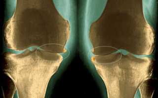 Артропатия коленного сустава и методы ее лечения