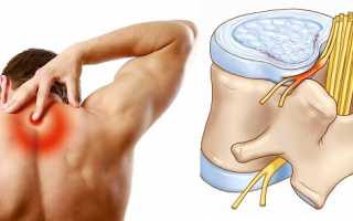 Виды и лечение фораминальной грыжи