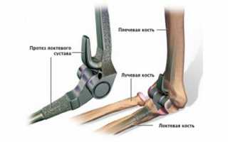 Замена локтевого сустава
