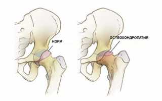 Остеохондропатия таза