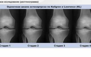 Рентген стадии остеоартроза
