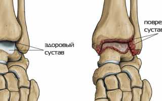 Голеностопный артроз