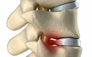 Грыжа межпозвоночного диска
