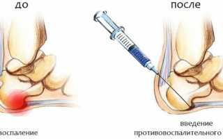 Лекарство от пяточной шпоры