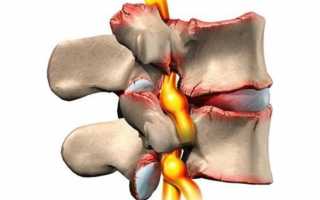 Симптомы и лечение полисегментарного спондилоартроза