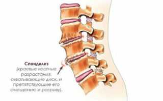 Что такое спондилез?