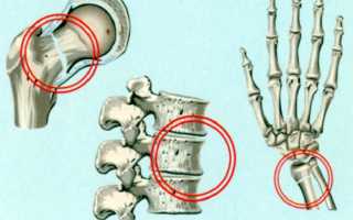 Переломы костей при остеопорозе