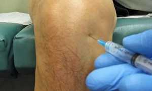 Лечение при остеоартрозе коленного сустава 2 степени