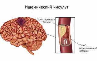 Инсульт и остеохондроз