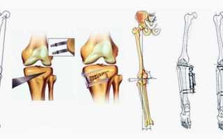 Остеотомия колена