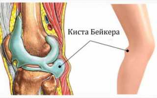 Лечение кисты Беккера в домашних условиях